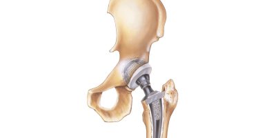 Hip Replacement Illustration